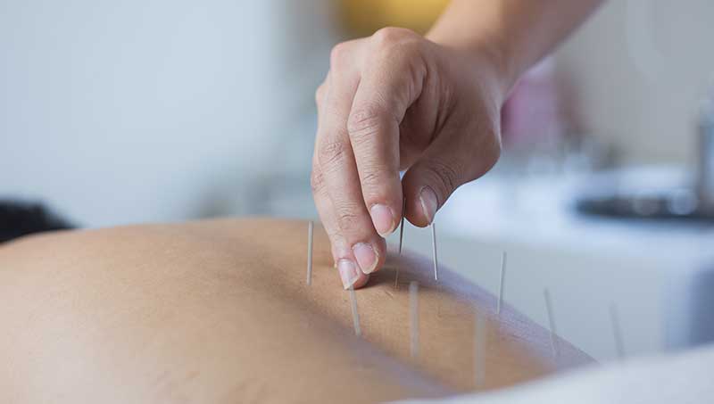 Does Acupuncture hurt?