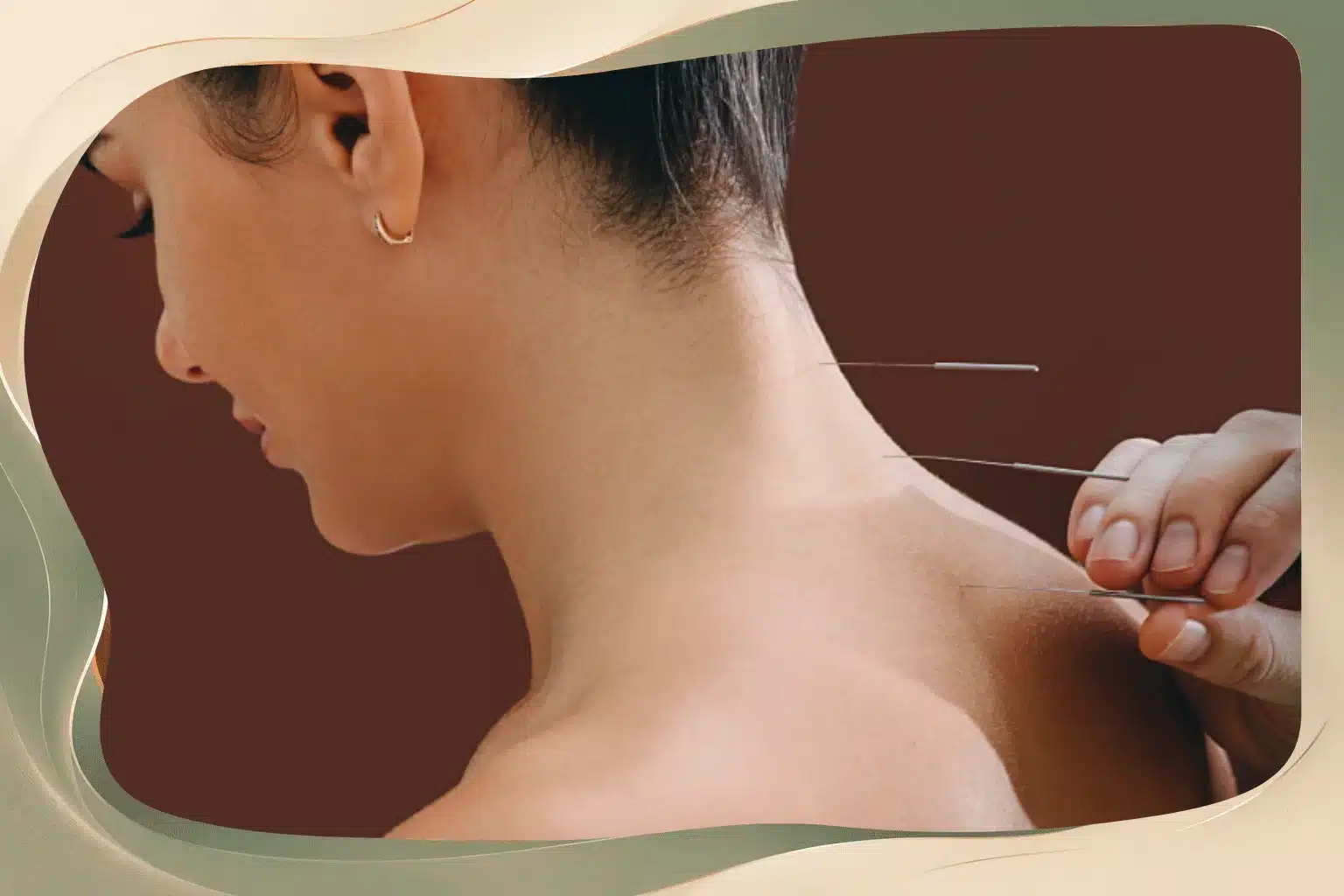 Acupuncture for Neck Pain Tips for Long Term Relief and Better Posture
