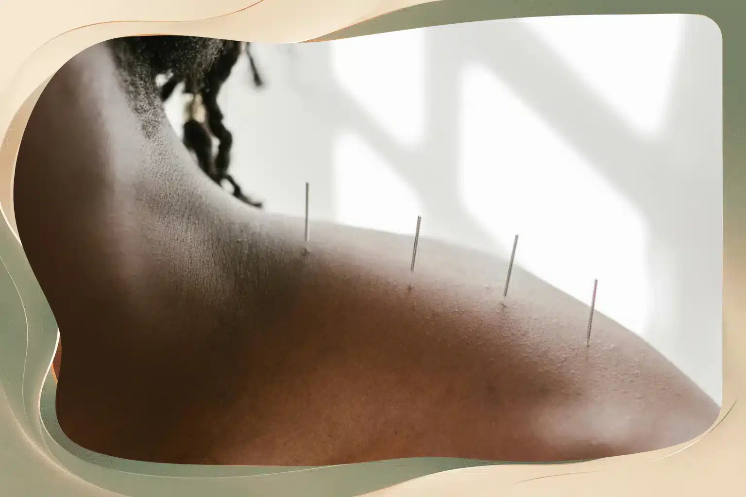 Can Acupuncture Help Neck Pain Caused by Desk Work